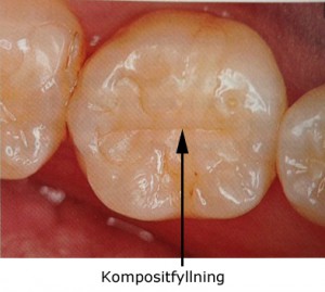 kompositfyllning_01_tandlakare