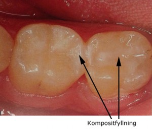 kompositfyllning_02_tandlakare