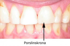 porslinskrona_02_tandlakare_olebratt